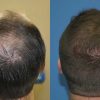 Hair Transplants in Chicago For Successful Results