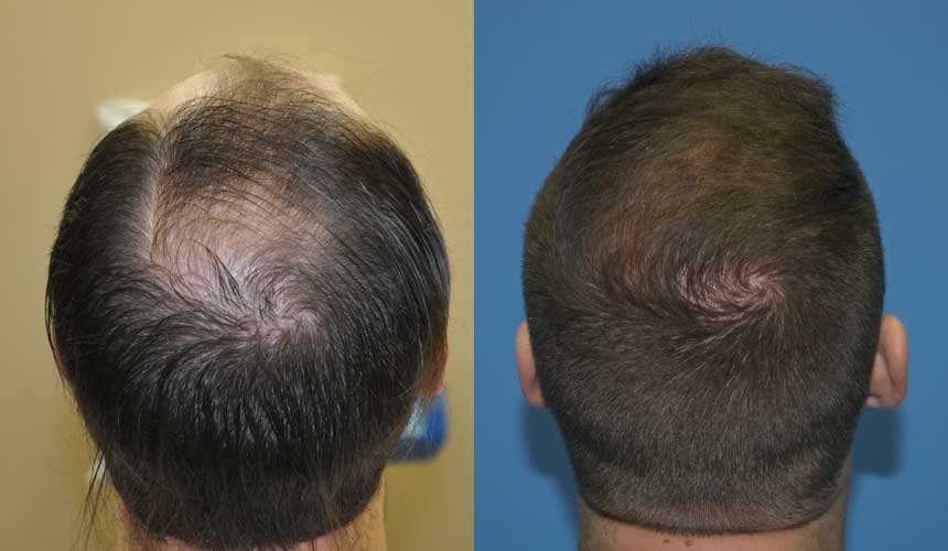 Hair Transplants in Chicago For Successful Results