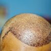 Hair Transplants For Men In Turkey