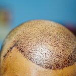 Hair Transplants For Men In Turkey
