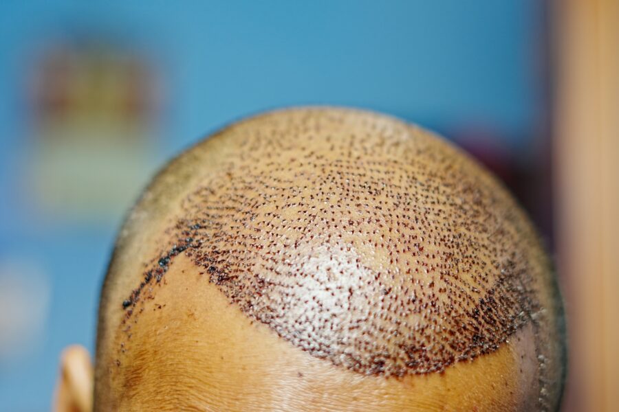 Hair Transplants For Men In Turkey